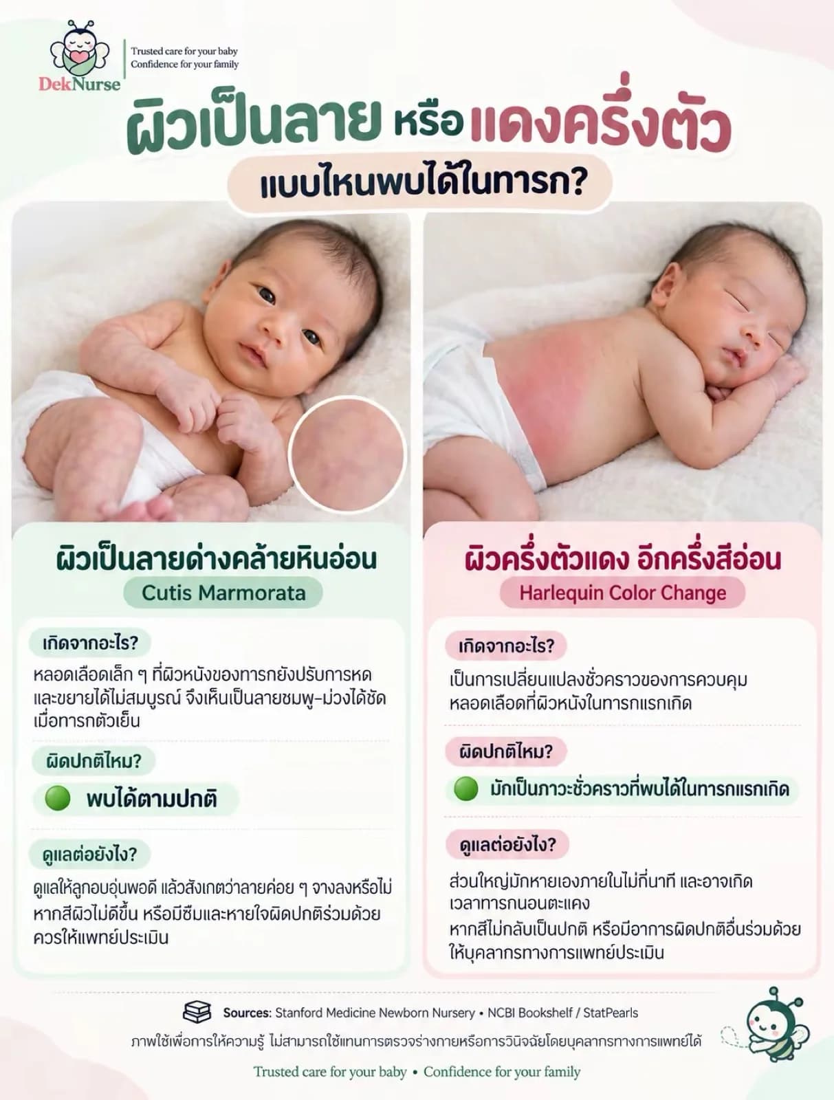 ภาพประกอบ: แผ่นความรู้เปรียบเทียบผิวเป็นลายด่างคล้ายหินอ่อนกับผิวแดงครึ่งตัวอีกครึ่งสีอ่อน อธิบายว่าทั้งสองแบบเป็นการเปลี่ยนแปลงชั่วคราวที่พบได้ในทารกแรกเกิด