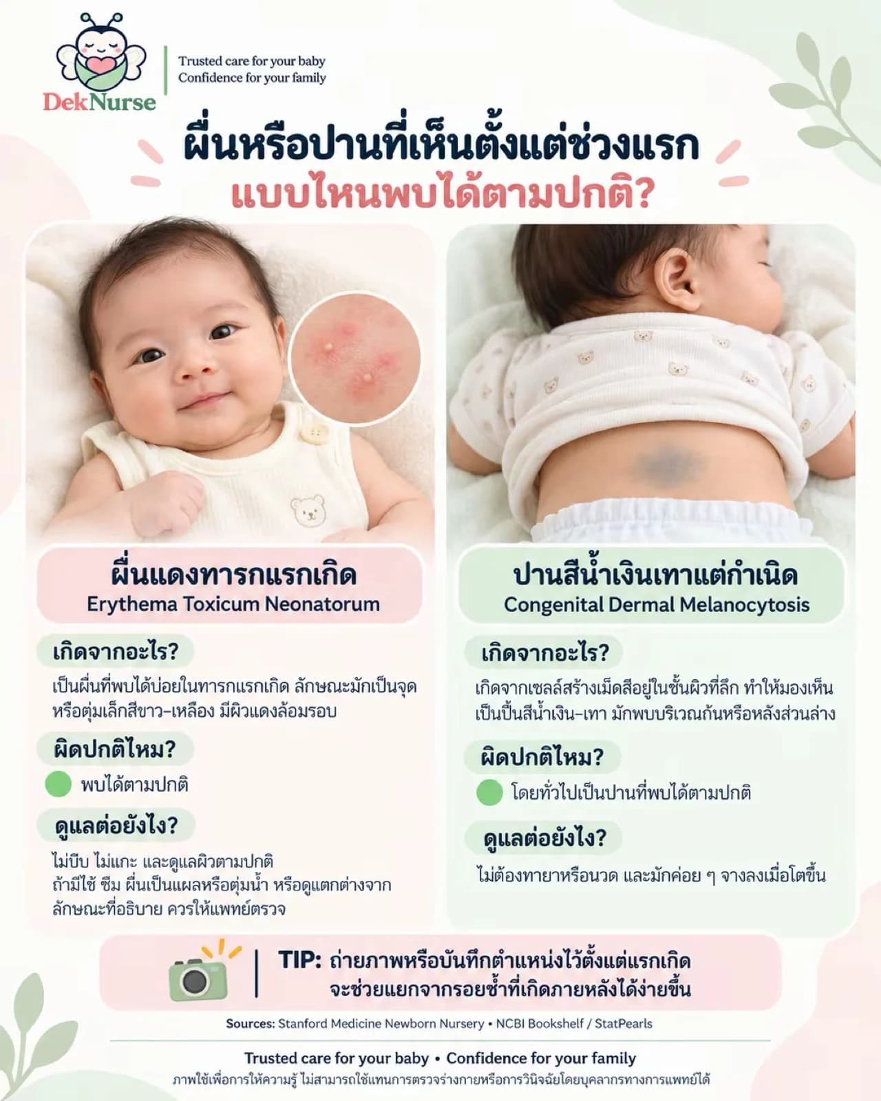 ภาพประกอบ: แผ่นความรู้เปรียบเทียบผื่นแดงทารกแรกเกิดกับปานสีน้ำเงินเทาแต่กำเนิด อธิบายสาเหตุและวิธีดูแลของแต่ละแบบ